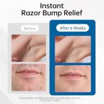 Razor Bumps Treatment for Bikini, Beard & Body