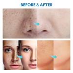 Razor Bump Stopper and Ingrown Hair Treatment