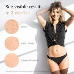 IPL Hair Removal Device with Cooling Technology