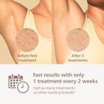 Philips Lumea 9000 IPL Hair Removal Device