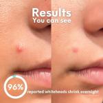 Skin Choice Acne Spot Patches – Clear Breakouts Fast