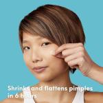 Skin Choice Acne Spot Patches – Clear Breakouts Fast