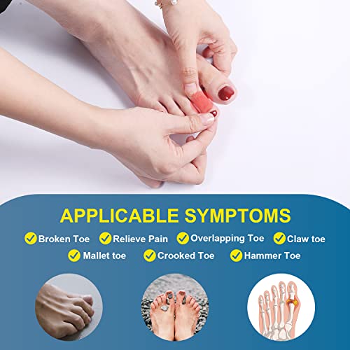 2pcs Toe Splints for Straightening, Dark Blue Toe Brace for Broken Toe straighteners for Hammer Toes Crooked Toes Bent Toes (2 Styles) from AIEX