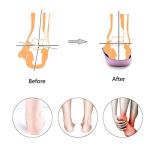 PCSsole 3/4 Orthotics Shoe Insoles High Arch Supports Shoe Inserts for Plantar Fasciitis, Flat Feet, Over-Pronation, Relief Heel Spur PainÂ  (S:Men5-6/Women6-7) by PCSsole