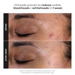 Paula's Choice BHA Exfoliant for Clear Skin