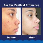 PanOxyl 10% Benzoyl Peroxide Acne Wash, 5.5 Oz