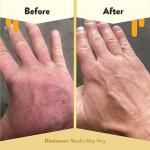 ECZEMA HONEY Gentle Foaming Hand Soap - Gentle Cleanser for Dry Hands - Non-Toxic Unscented Hand Soap - Natural Hand Cleaner for Bathroom & Kitchen - Organic Honey Handwash (8.4 Oz)