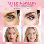 FSA Red Light Therapy Mask : Target Acne Removal,Wrinkles Redness,Wirless Remote,Salon Grade HSA Infrared Face Mask, Anti Aging Skincare for Home ,2000mAh Rechargeable Led Light Therapy Facial Mask