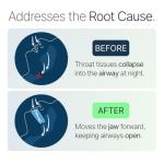 Somnofit-S Anti-Snore Mouth Guard by SnoreLessNow | Made in Switzerland | FDA Cleared | Most Comfortable Anti Snoring Mouthpiece | Sleep Tight Mouth Guard | Adjustable Snoring Solution for Men & Women