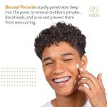 AcneFree Terminator 10 Spot Treatment, 1 Ounce