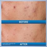 CeraVe Acne Control Gel with Salicylic Acid