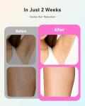 Pink Laser Hair Removal Device for Women