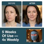 MyHalos® LED Light Therapy Face Mask for Skin