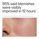 INKEY List Succinic Acid Acne Treatment 15ml