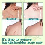 Tea Tree Oil Back Acne Treatment Spray