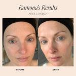 Pro-Radiance Enzyme Peel - Brightening Face Mask