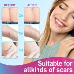 Scar Removal Silicone Tape for Hypertrophic Scars & Keloids, 1.6'' x 60''-150"