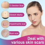 Scar Removal Silicone Tape for Hypertrophic Scars & Keloids, 1.6'' x 60''-150"