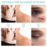 Scar Removal Silicone Tape for Hypertrophic Scars & Keloids, 1.6'' x 60''-150"
