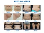 360° Cryotherapy Fat Loss Slimming Machine