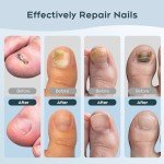 Home Nail Fungus Laser Device with Dual Lights