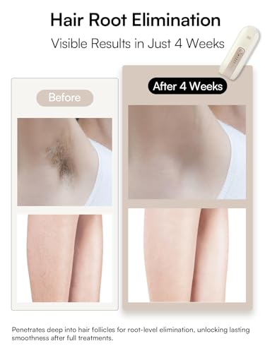 INIA Laser Hair Removal Device for Women and Men