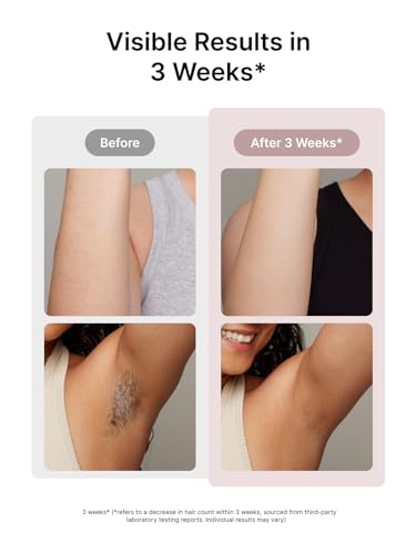 Ulike Laser Hair Removal - Painless & Long-Lasting Results
