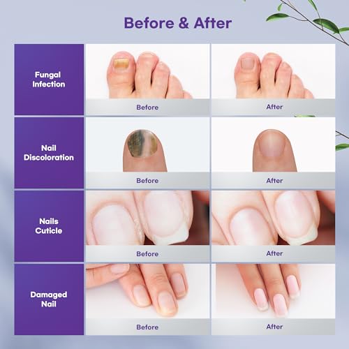 Extra Strength Toenail Fungus Treatment Spray (100 mL)