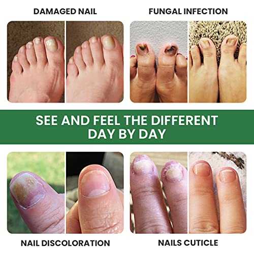 Extra Strength Toenail Renewal Solution - 2 Pack