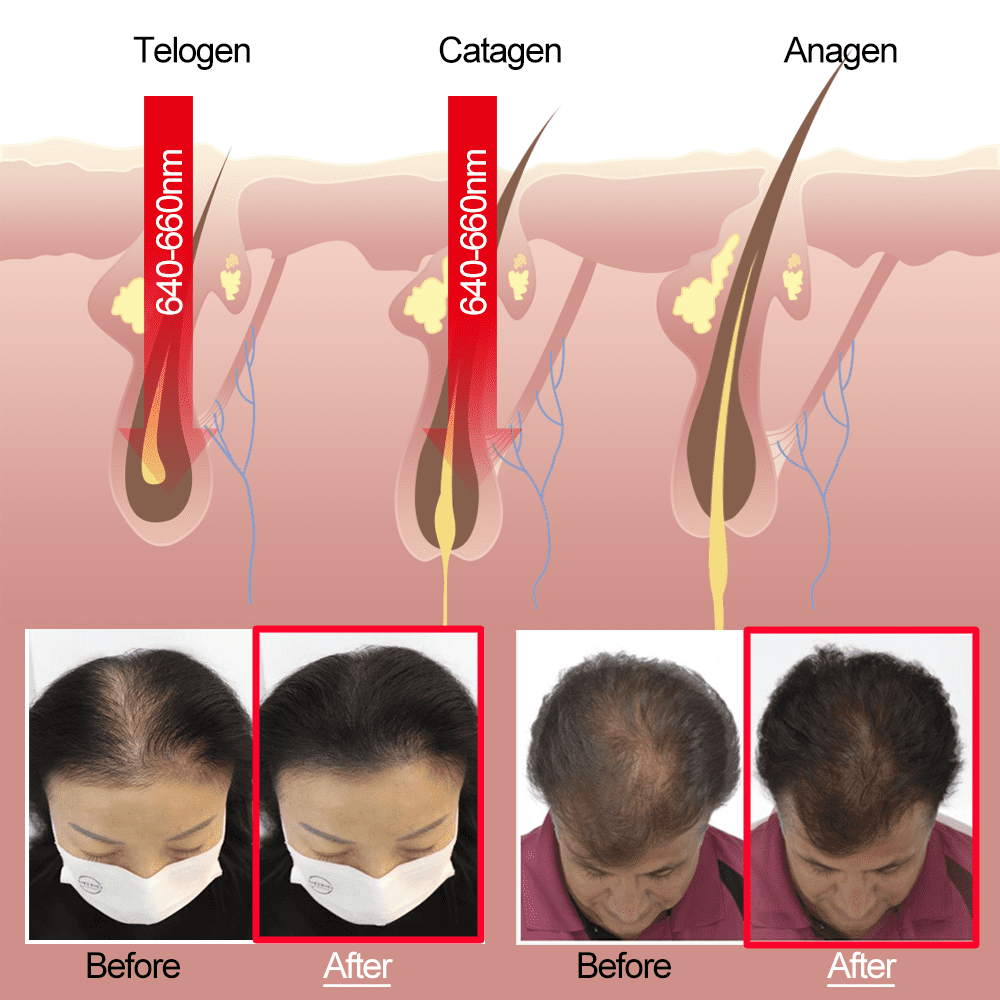 Lescolton Hair Regrowth Laser Helmet - Thinning Hair Solution