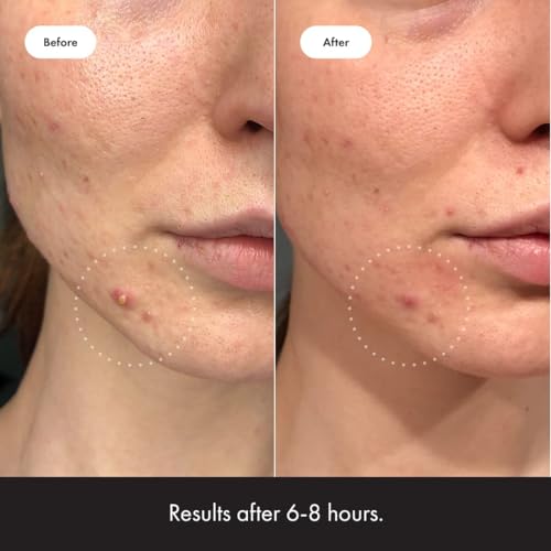Invisible Hydrocolloid Acne Pimple Patches - Mighty Patch™