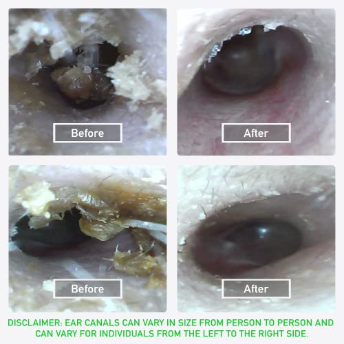 Wireless Otoscope with LED Light - Ear Care Kit