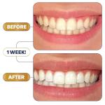 Lumineux Teeth Whitening Strips - 21 Treatments