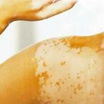 GLISODin V SOD - Antioxidant Support for Skin