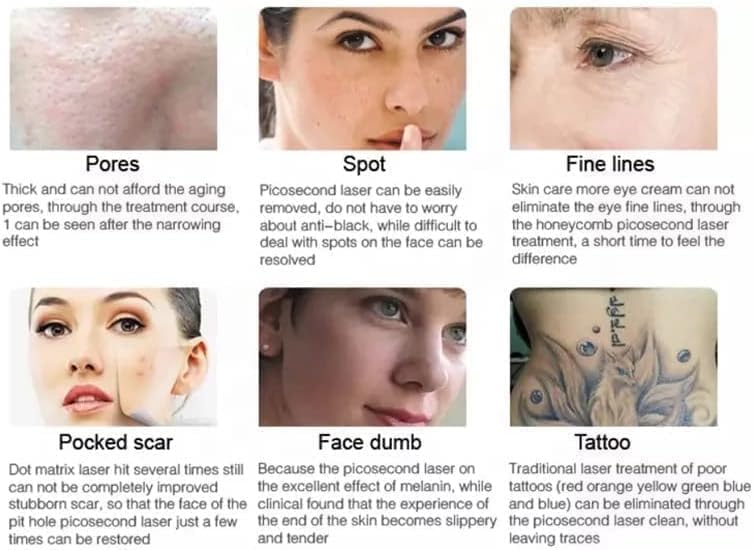 GURSAC Professional Laser Tattoo Removal Machine