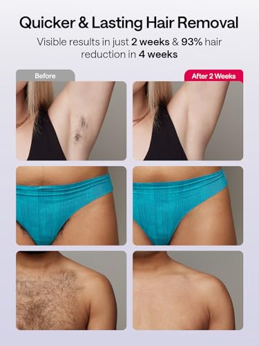 Ulike Air 10 IPL Laser Hair Removal Device