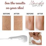 Mandy IPL Hair Removal Device for Home Use