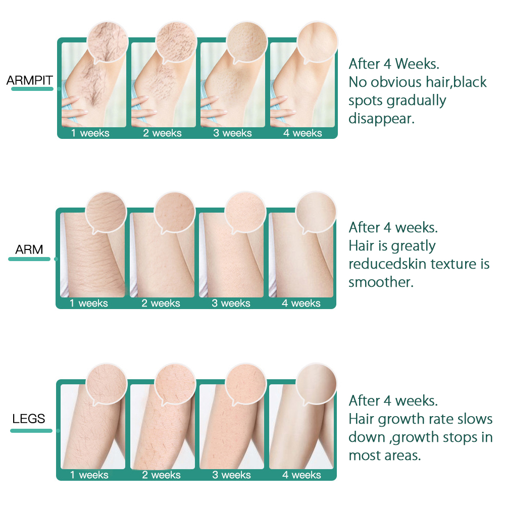 Ponyta IPL Laser Hair Removal for Women