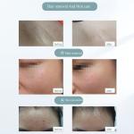 TureClos 900000 Flashes Painless Laser Hair Removal