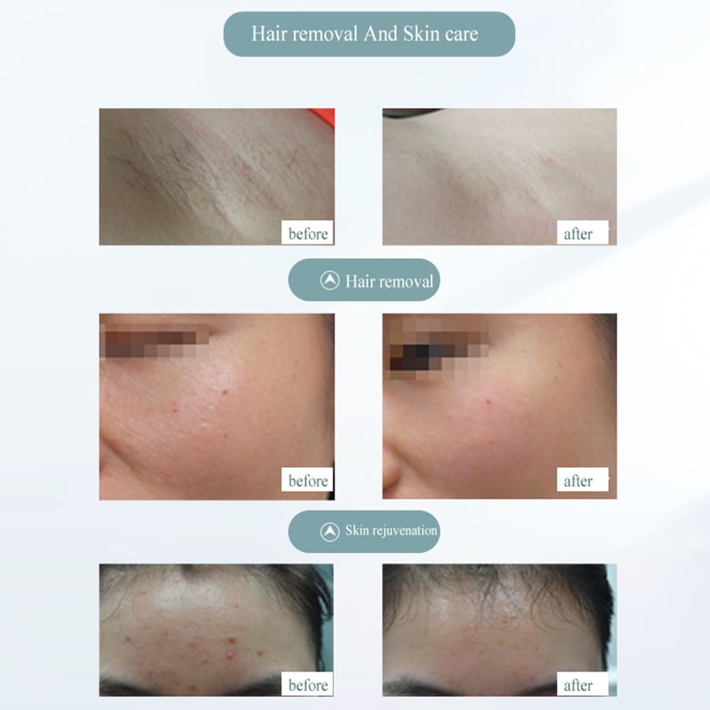 TureClos 900000 Flashes Painless Laser Hair Removal