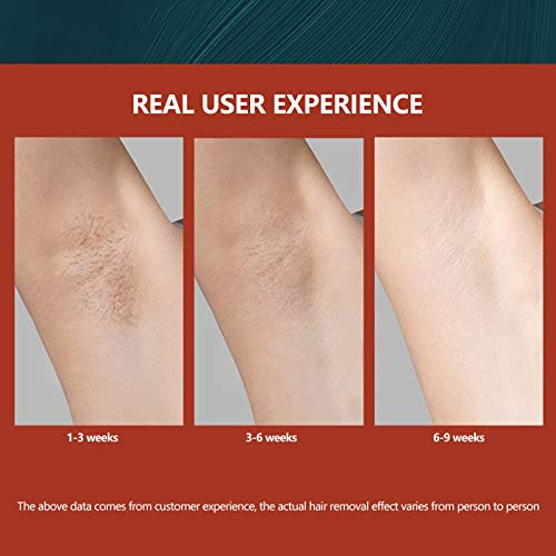Portable Laser Hair Removal Device with Ice Technology