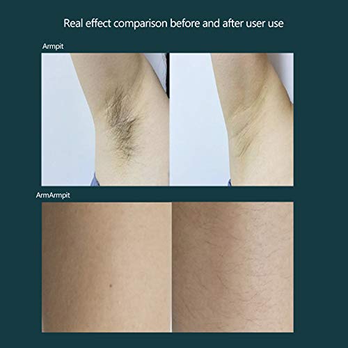 Portable Laser Hair Removal Device with Ice Technology