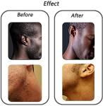 Exfoliating Brush for Razor Bumps and Ingrown Hairs