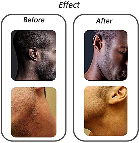 Exfoliating Brush for Razor Bumps and Ingrown Hairs