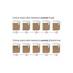 Philips Lumea Advanced IPL Hair Removal Device