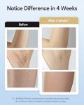 Pain-Free IPL Hair Removal Device with Cooling