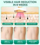 Upgraded IPL Laser Hair Removal Device with Cooling