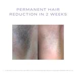 SKINEV8 IPL Hair Removal System with Cooling