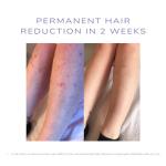 SKINEV8 IPL Hair Removal System with Cooling