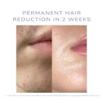 SKINEV8 IPL Hair Removal System with Cooling